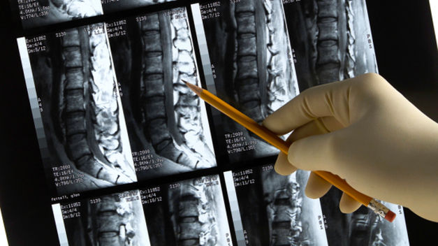 La columna vertebral y hernias discales